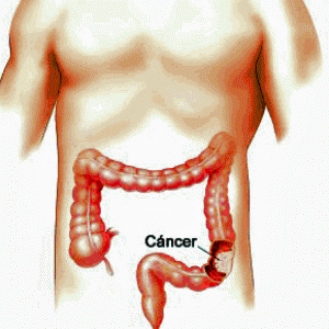 cancer-de-colon
