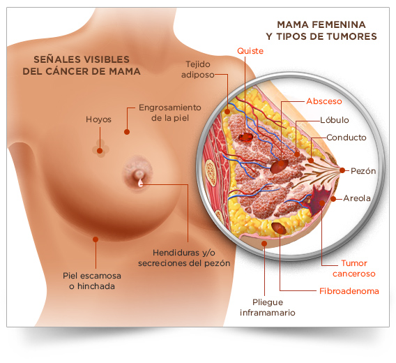 cancer-mama-tejido-mamario-seno